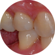 Overeruption of opposite toot